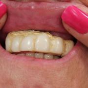 Beauty disaster victim showing dental implants before corrections