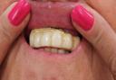 Beauty disaster victim showing dental implants before corrections